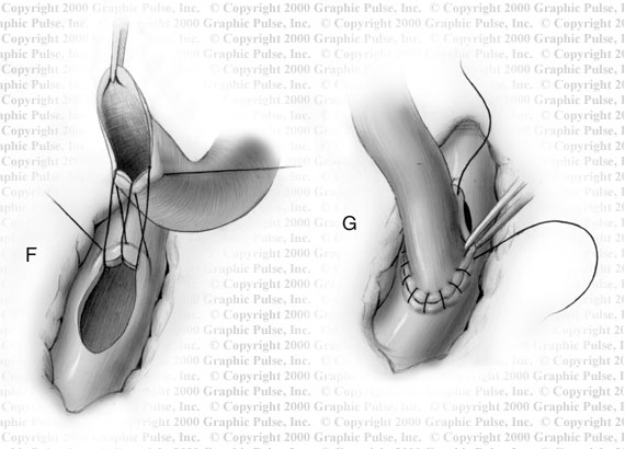 Coronary artery surgical illustration