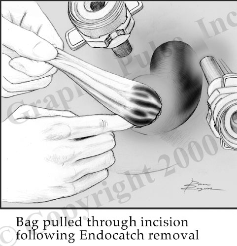 Kidney surgical medical illustration